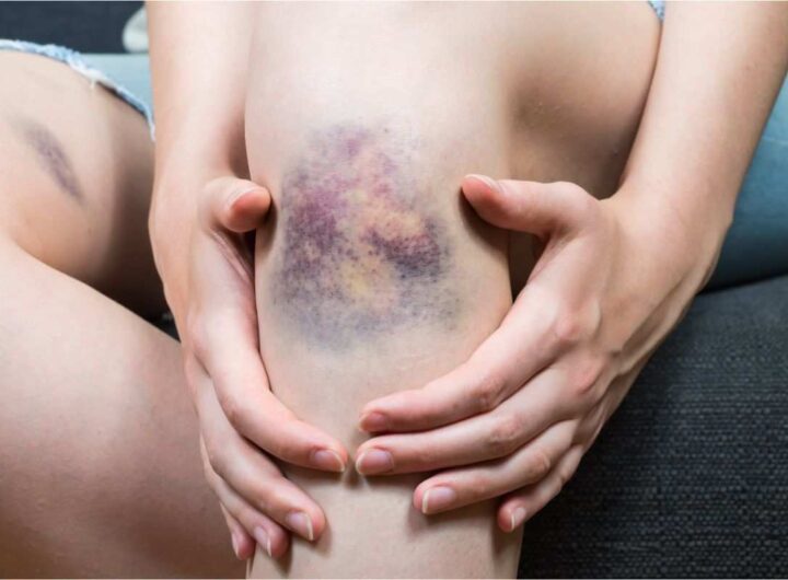 Leucemia, sintomi e cura